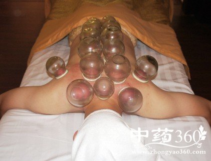 拔罐疗法发展概况