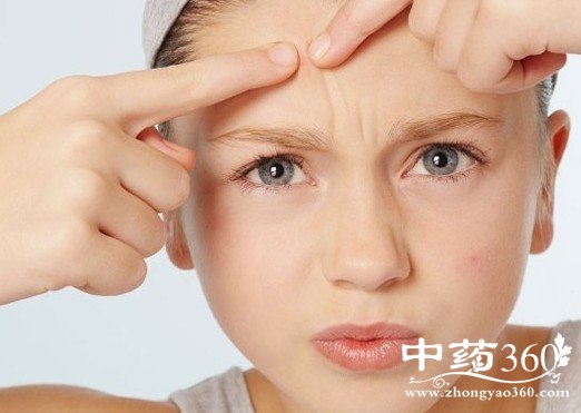 中医祛痘的方法