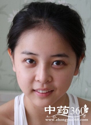 黄褐斑能去掉吗,孕期有效预防黄褐斑的方法