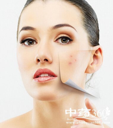 中医祛痘的方法