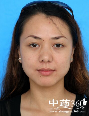 有青春痘怎么办,青春痘患者饮食禁忌有哪些?