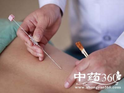 针灸祛痘的好方法