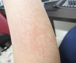 Ƥ����������ҩ����Щ����