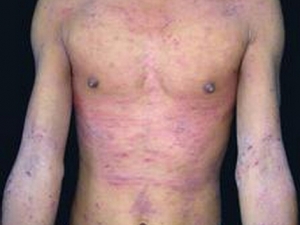 ����Ƥ�׵��γ�ԭ�� ����Ƥ��ƫ��