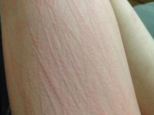 导致血热的原因及缓解血热的方法