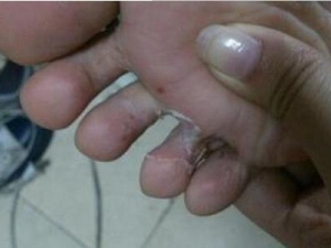 �ŵװ���Ƥ�ѿڵ�ԭ�� ��Ƥ�ѿ���ô��