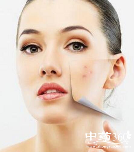 针对不同痘痘的中医去除方法