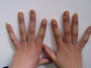 ������ӲƤ����֢״ ������ӲƤ����Σ��