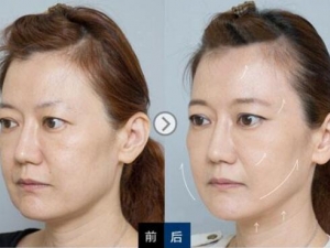 ľż����ʲô�����Ԥ��ľż��