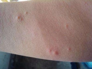 Ѫ��Ƥ������ô�� Ѫ��Ƥ������ʲô��