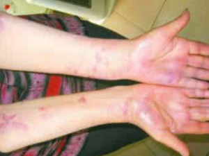 ��ô����Ƥ�� ��ҽ������ô����