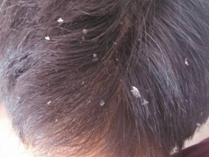 ���ȥ��ͷƤм ȥͷƤм��ʲô��