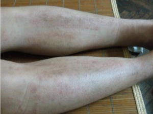 �ļ�Ƥ�׵�ԭ�� �ļ�Ƥ����ô�� �ļ�Ƥ����ʲôҩ��