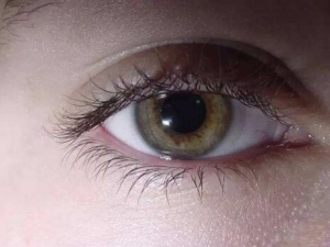 ��Ĥ�׵�֢״ ���Ԥ����Ĥ�� ��α����۽�Ĥ