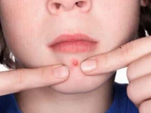 �촽��Χ��������ԭ�� �촽��Χ��������ô��