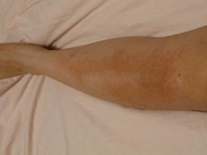 ʪ��ܳ�ʲô ʪ��������� ����ʪ���ƫ���Ƽ�