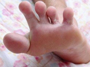 ����Ƥ��ԭ�� ����Ƥ��Ӱ�������� ����Ƥ��ô��