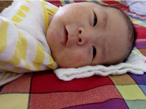 �շ�Ӥ��ʪ���ԭ��  Ԥ��Ӥ��ʪ���ע������