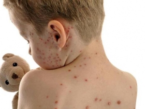 ��ˮ����ʲô�� ��ˮ������ʳ���� ��ˮ���ᴫȾ��