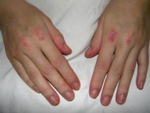 ��Ƥ���׵�ԭ�� Ƥ���׻��ߵ���ʳ���� Ƥ������ʳ��ʲô��