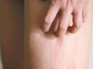 Ƥ��ɦ����֢״ Ƥ��ɦ���������