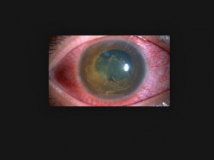 ����Ĥ�׵�Σ�� ����Ĥ�׵����Ʒ���