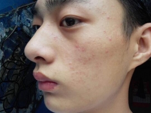 ë�׶�����ô�� ȥ��ë�׶����ķ�������Щ