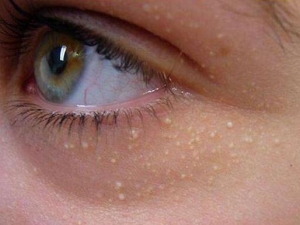 ���Ԥ���۲�֬���� ȥ��֬�����ķ����Ƽ�