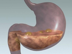 �޴�ʺ���θ�׵�ԭ�� �޴�ʺ���θ����ν�����ʳ����