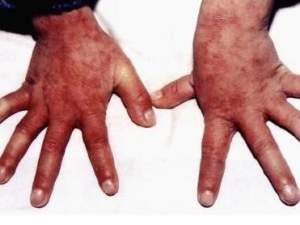 ���������֢״ �������������ƫ��