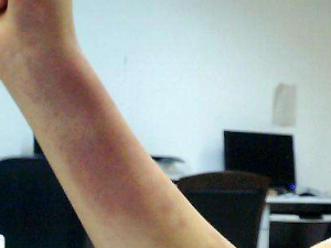 �ж��Ժ������Щ֢״ �ж��Ժ�ߵ�����ƫ��