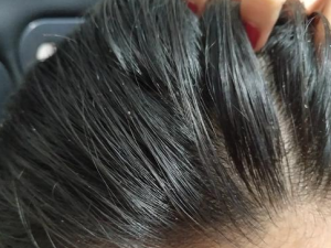 ��ʲô�ܷ�ֹ�ѷ� ��ҽ����Щ����