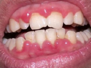 θ������Щ֢״ �Ƽ���ҽ8��ƫ������θ��