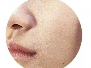 Ƥ������һ�㱣�ֶ೤���� Ƥ�����׵ķ���