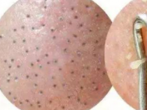 ��ͬ����Ƥ��˥����ʲô��ͬ ���Ԥ��Ƥ��˥��