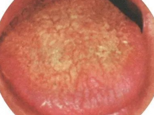 ��̦�Ƶ�ԭ������Щ ��̦�Ƶ�����ƫ��