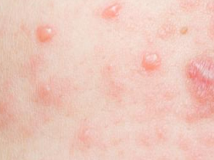 ��ʪ�����ע����ʳ ��ʪ��Ӧ�ɳ���Щʳ��