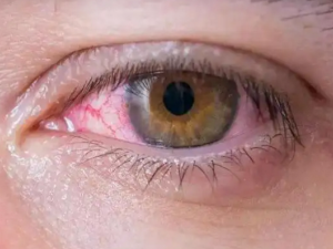 �۾��к�Ѫ˿��ô�� �Ƽ������۾���Ѫ˿��������