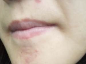 ����ȷ�ڱǿ�����Щ���� �ڱǿ׶����������ЩΣ��