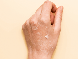 ��θ���Ƥ����Ƥ֢״ Ƥ����Ƥ�Ļ�������