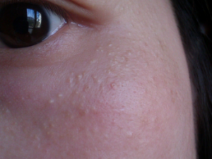 ��ҽ���Ԥ��֬���� ���Ӱ�Ħ����������֬����