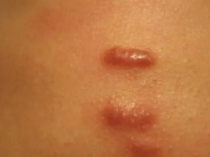 �ۻ���ȥ���� ��ҽ���η�������ȥ����