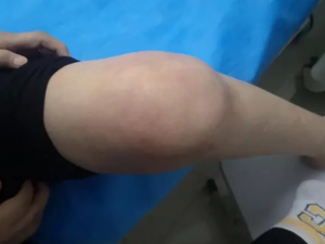 ��ʪ�Թؽ��׵���ҽ����ƫ�� ��ʪ�Թؽ��׵�֢״