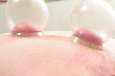 拔火罐后的紫印子怎么消除