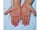 什么是手足口病 手足口病的症状有哪些？