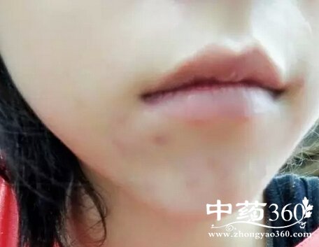 下巴长痘怎么办 祛除痘痘有效方法