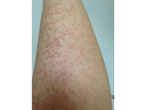 �����������ô�� ��ҽ���ư취����æ