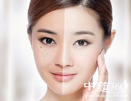 黄褐斑形成因素有哪些?