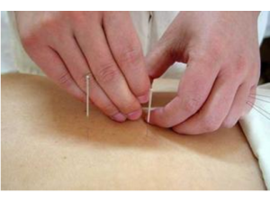 中医详解针灸美与祛眼袋