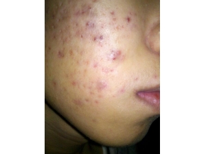 去除痤疮可用12偏方 调理只需用5招